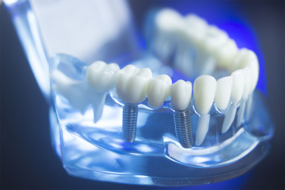 Dental_Implants_model